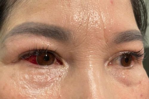 Làm gì để phòng viêm kết mạc mắt trong mùa mưa lũ?
