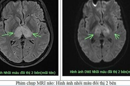Nhiều người Việt thường mắc phải thói quen này dẫn đến đột quỵ não