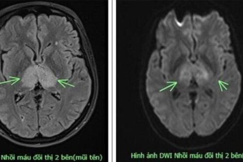Đau đầu suốt 4 ngày không khỏi, đi khám mới biết mắc bệnh nguy hiểm, hiếm gặp