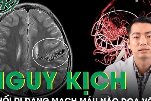 Bệnh nhi nguy kịch vì khối dị dạng mạch máu não dọa vỡ