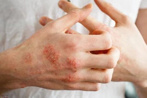 Các bệnh ngoài da thường gặp sau mưa lũ