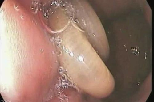 Giun dài đến 10 cm lúc nhúc trong cơ thể người đàn ông