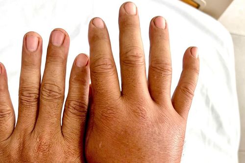 Cảnh báo gia tăng số người bị rết cắn sau mưa bão