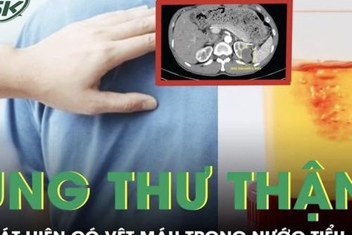 Bàng hoàng phát hiện ung thư thận từ dấu hiệu lạ trong nước tiểu