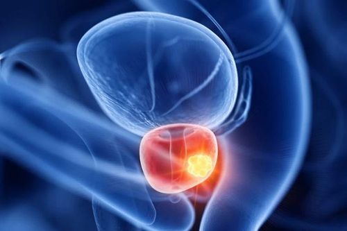 Đột phá mới giúp cải thiện đáng kể ung thư tuyến tiền liệt giai đoạn đầu