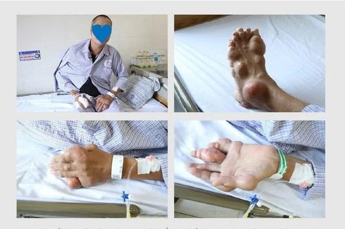Chủ quan không điều trị bệnh Gout, người đàn ông bị biến dạng tay chân