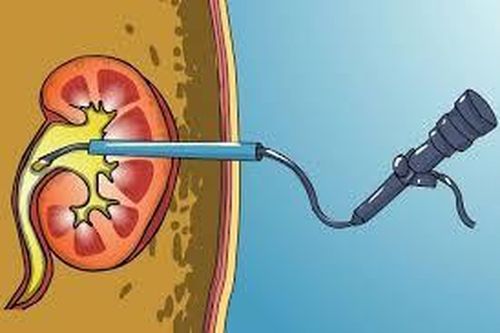 Sỏi niệu quản to 1,5cm điều trị thế nào mới hiệu quả?