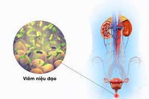 Viêm niệu đạo cần làm gì để tránh tái viêm?