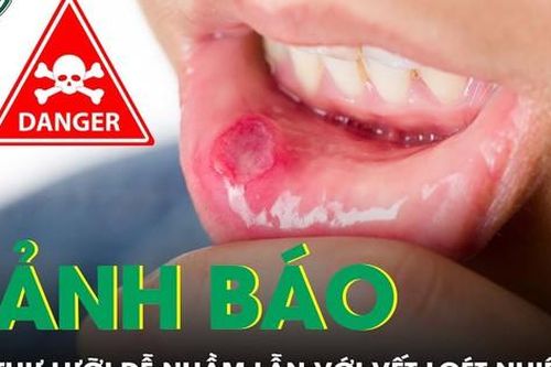 Ung thư bờ lưỡi dễ bị nhầm lẫn với vết loét nhiệt miệng