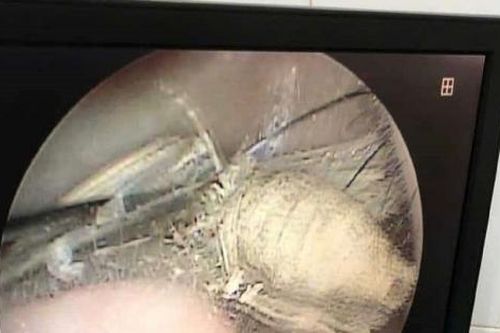 Phát hiện côn trùng dài 3 cm sống lâu ngày trong tai
