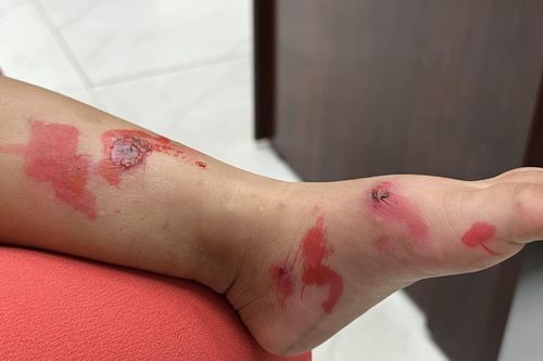 Bác sĩ cảnh báo gia tăng một loại bệnh nhiễm trùng da ở trẻ em trong trường học