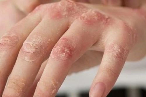 Hà Nội: Hơn 500 người mắc bệnh da liễu sau bão Yagi