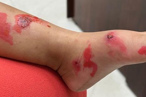 Cảnh báo bệnh nhiễm trùng ngoài da thường gặp ở trẻ độ tuổi mẫu giáo