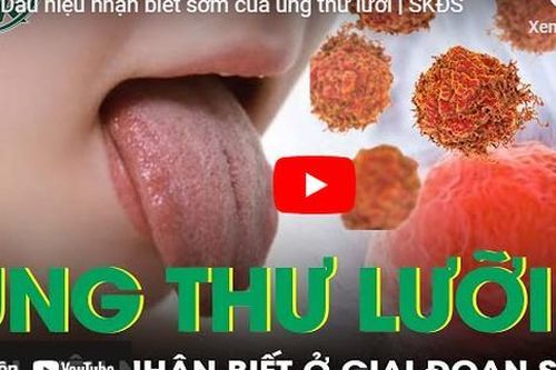 Dấu hiệu nhận biết sớm của ung thư lưỡi