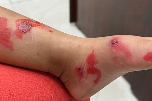 Bác sĩ da liễu cảnh báo nguy cơ lây lan bệnh chốc ở trường học