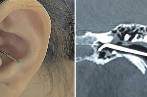 Bác sĩ cảnh báo tổn thương tai nếu bạn có thói quen lấy ráy tai, lau khô tai bằng tăm bông