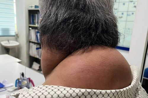 Mắc bệnh 'người gấu' vì thói quen xấu khó bỏ