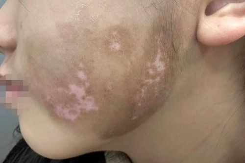 Nguyên nhân, triệu chứng, cách điều trị bệnh bạch biến