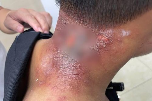 Nấm da, nhiễm trùng da mùa mưa lũ, chuyên gia da liễu khuyến cáo