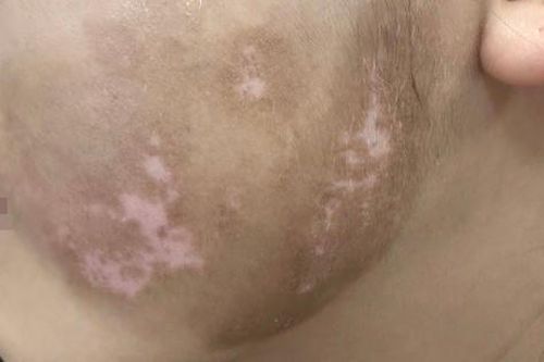 Bạch biến: Nguyên nhân, triệu chứng, cách điều trị và phòng ngừa