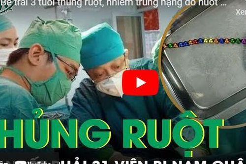 Bé trai 3 tuổi thủng ruột, nhiễm trùng nặng do nuốt 31 viên bi