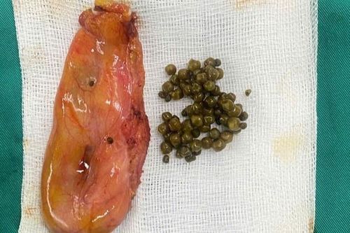 Hàng chục viên sỏi trong túi mật nam thanh niên 28 tuổi