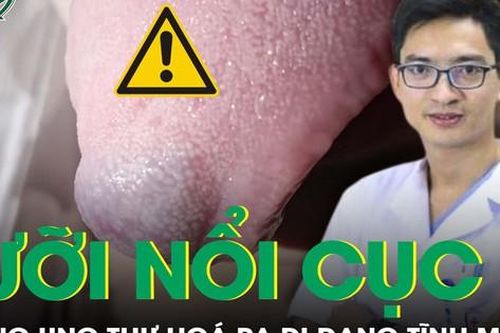 Lưỡi nổi u cục tưởng ung thư, đi khám phát hiện dị dạng tĩnh mạch
