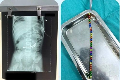 Bé trai 3 tuổi bị thủng ruột vì nuốt 31 viên nam châm