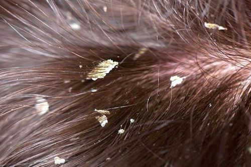 Gàu da đầu do đâu và cách khắc phục