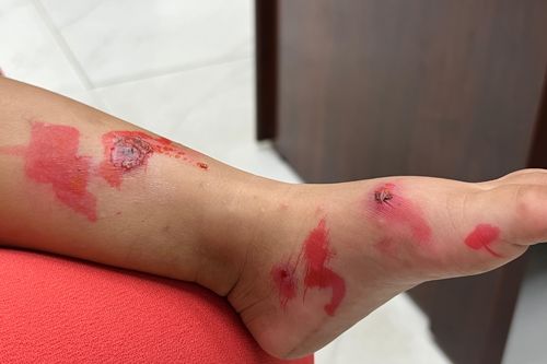 Đi học trở lại, bệnh chốc lây lan nhanh ở trẻ