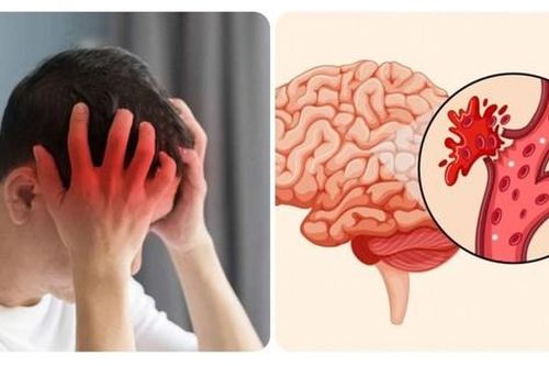 Ai cần tầm soát đột quỵ?