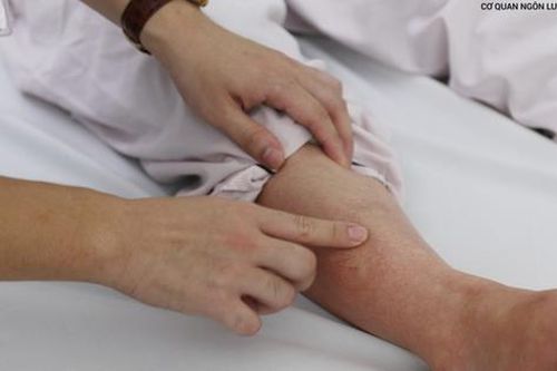 Mùa mưa lũ cẩn thận với sốt xuất huyết