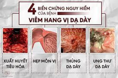 Viêm hang vị dạ dày do vi khuẩn HP có thể điều trị dứt điểm không?