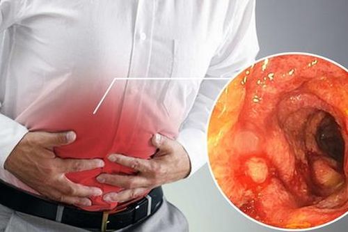 Câu hỏi thường gặp liên quan đến viêm đại tràng