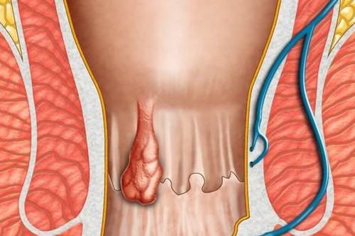 Cách chữa bệnh trĩ tại nhà hiệu quả