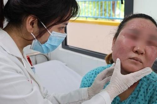 Gặp biến chứng nặng khi tự 'peel' da tại nhà