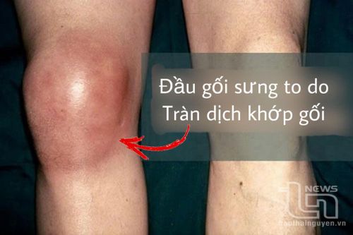 Cẩn trọng khi điều trị bệnh lý khớp tại cơ sở không chuyên