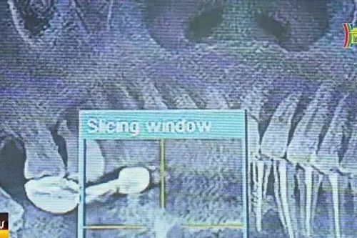 Ứng dụng các kỹ thuật mới trong điều trị nha khoa