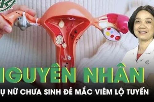 Phụ nữ chưa sinh đẻ mắc viêm lộ tuyến, nguyên nhân do đâu?