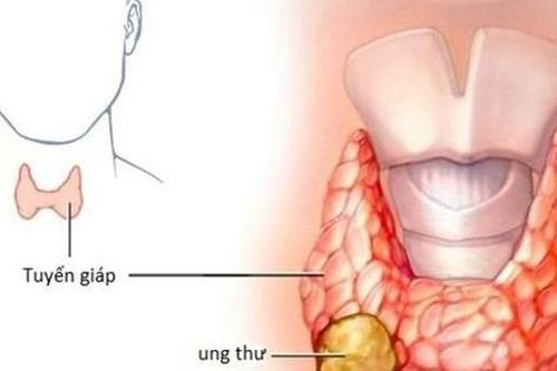 Các dấu hiệu điển hình của ung thư tuyến giáp ai cũng cần biết