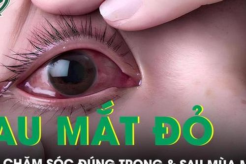 Xử trí đau mắt đỏ trong mùa mưa lũ thế nào?