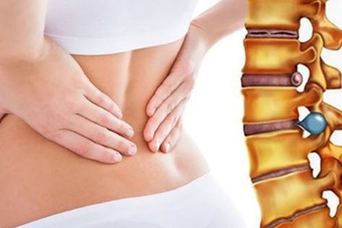Thoát vị đĩa đệm có nên mổ không?