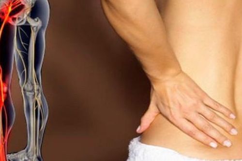 Chữa đau thần kinh tọa hiệu quả
