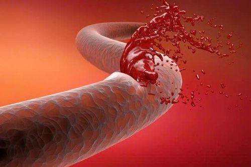 Thuốc và phương pháp điều trị giãn tĩnh mạch thực quản