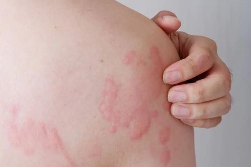 Cách xử lý khi nổi mề đay