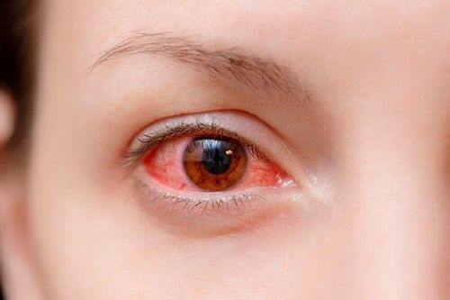 Làm gì để tránh bị đau mắt đỏ?