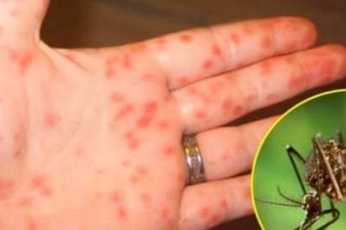 5 lưu ý cực kỳ quan trọng để phòng ngừa sốt xuất huyết sau mùa mưa lũ