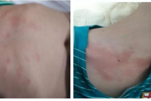 Phát hiện trẻ 3 tuổi mắc viêm khớp thiếu niên