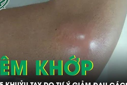 Áp xe khuỷu tay trái do tự ý tiêm khớp giảm đau