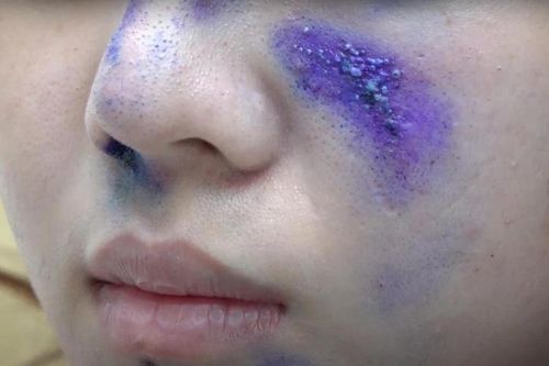 Dùng thuốc gì khi bị kiến ba khoang đốt?